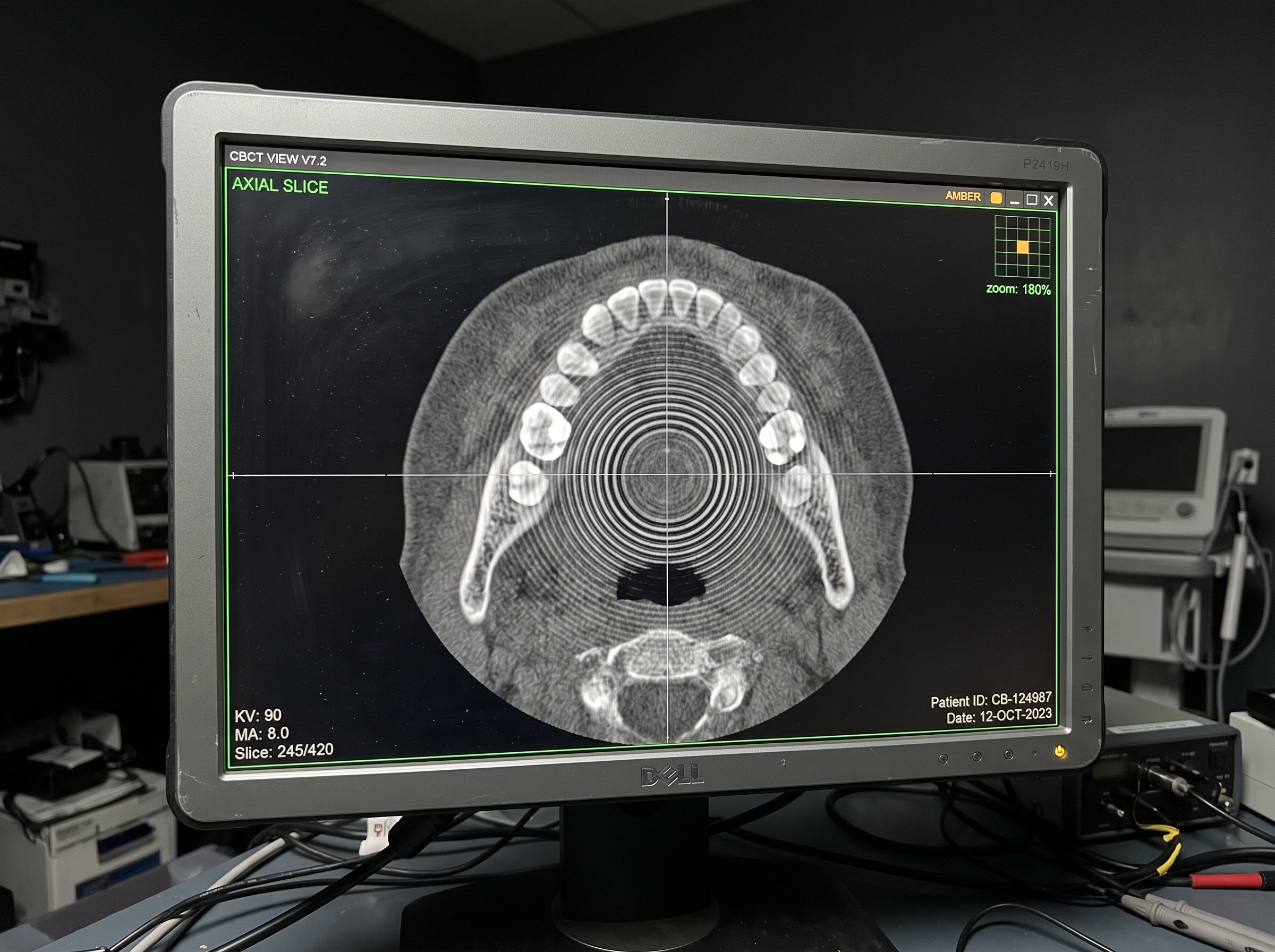 Axial CBCT slice on a monitor showing concentric ring artifacts centered on the reconstruction axis